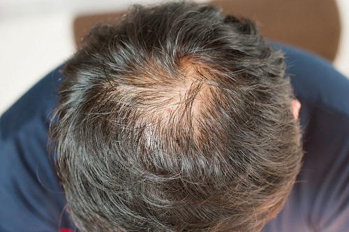 caida-del-cabello-aceite-de-coco.jpg