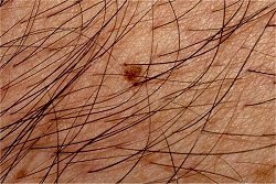 PediculosisPubis3.jpg