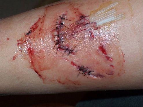 sharikayt_bite_wound_for_web.jpg